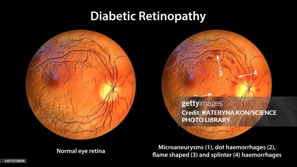 Retina damage from diabetes, illustration