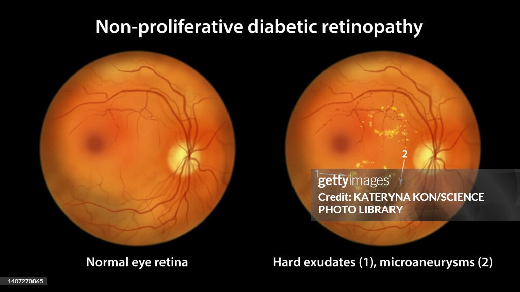 Retina damage from diabetes, illustration