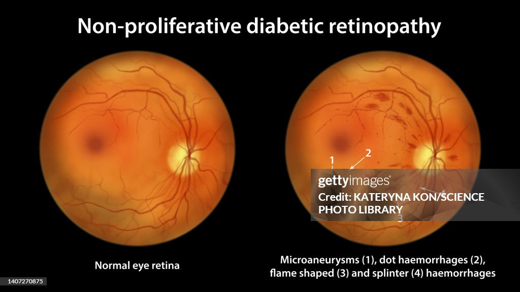 Retina damage from diabetes, illustration