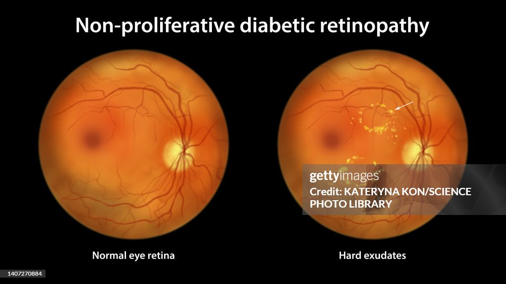 Retina damage from diabetes, illustration