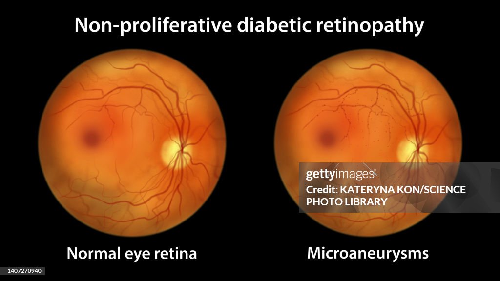 Retina damage from diabetes, illustration