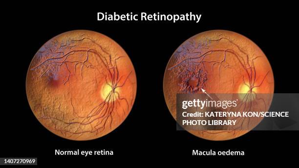 retina damage from diabetes, illustration - retina stock illustrations