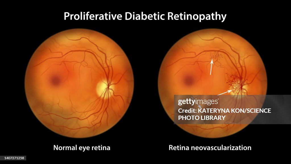 Retina damage from diabetes, illustration