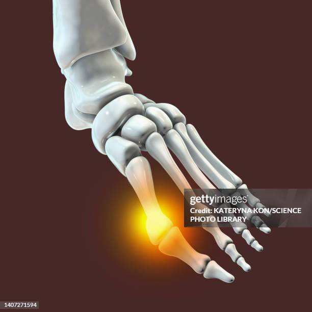 bunion, illustration - hallux valgus stock illustrations