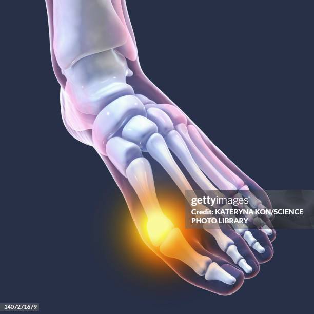 illustrazioni stock, clip art, cartoni animati e icone di tendenza di bunion, illustration - hallux valgus