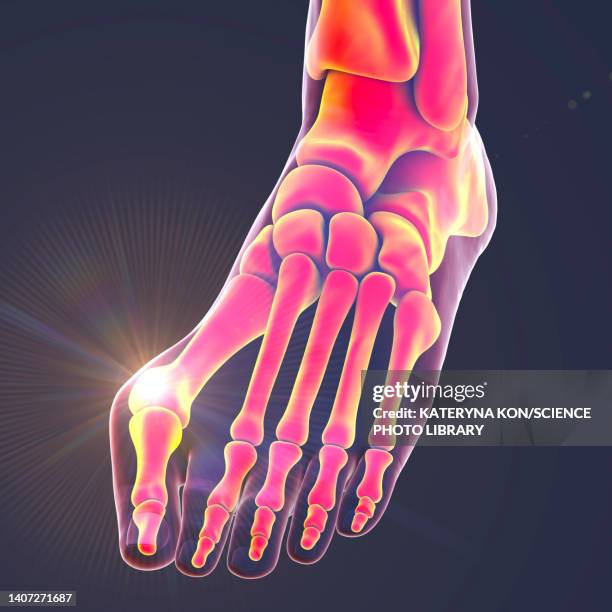 bunion, illustration - bunion stock-grafiken, -clipart, -cartoons und -symbole