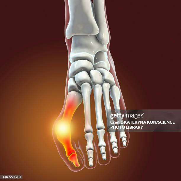 bunion, illustration - bunion stock-grafiken, -clipart, -cartoons und -symbole