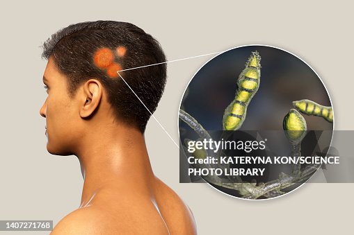 Ringworm Illustration High-Res Vector Graphic - Getty Images