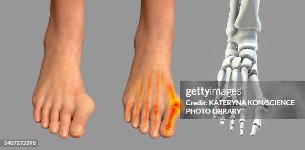 bunion, illustration - hallux valgus stock illustrations