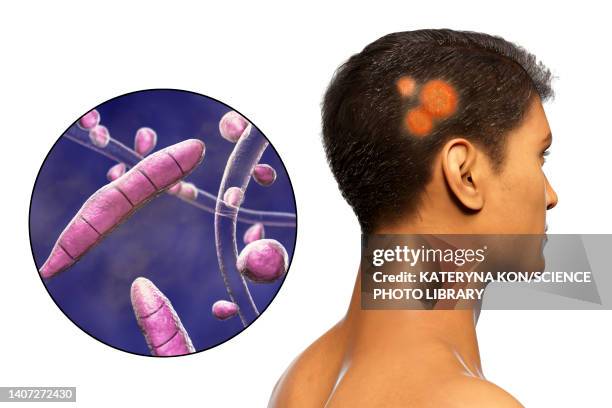 ringworm, illustration - pilzkopf stock-grafiken, -clipart, -cartoons und -symbole