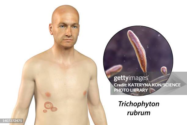ringworm, illustration - albino stock illustrations