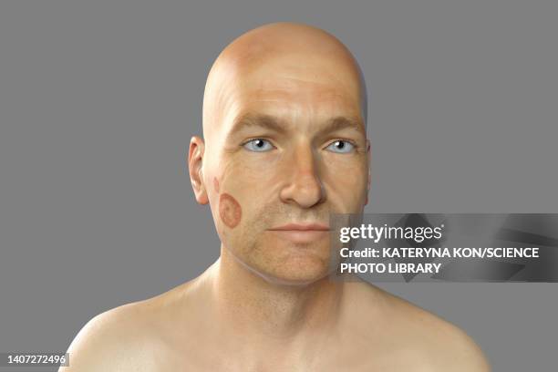 ringworm, illustration - albino stock illustrations