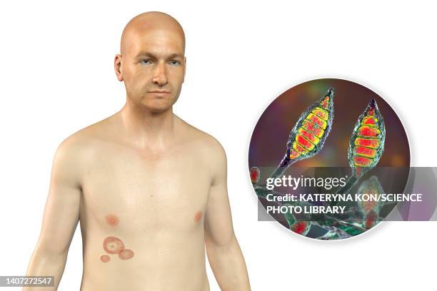 ringworm, illustration - man scratching stock illustrations