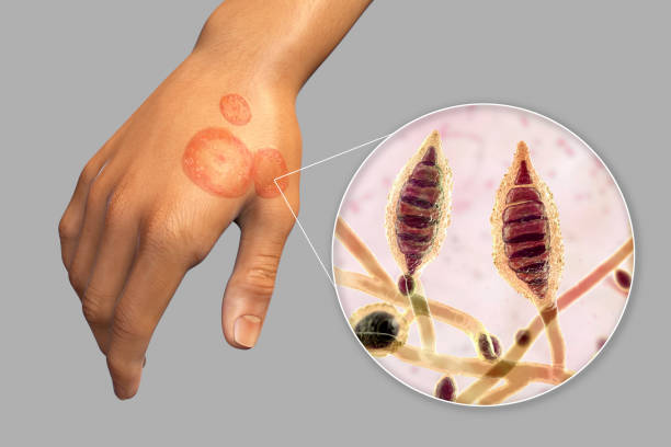 Food Allergy Hives High Res Illustrations - Getty Images