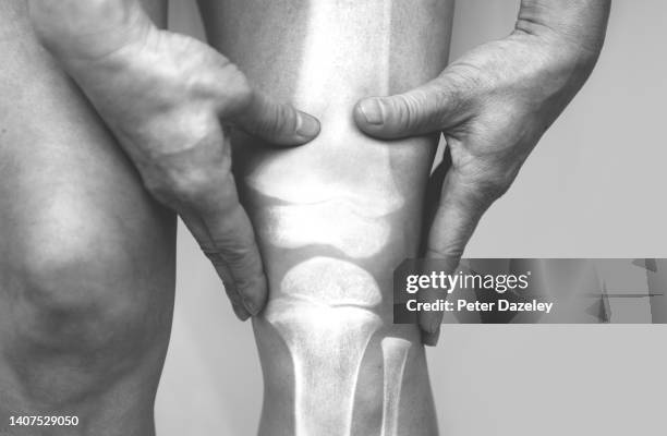 knee joint pain - cartilage bildbanksfoton och bilder