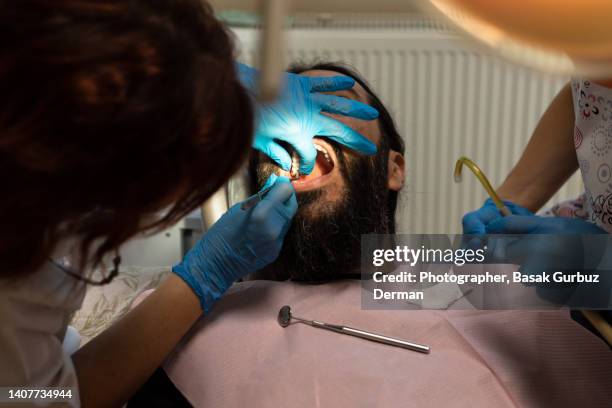 medical procedure at dentist. dentist placing the dental implant into male patient's mouth. - implante dentário - fotografias e filmes do acervo