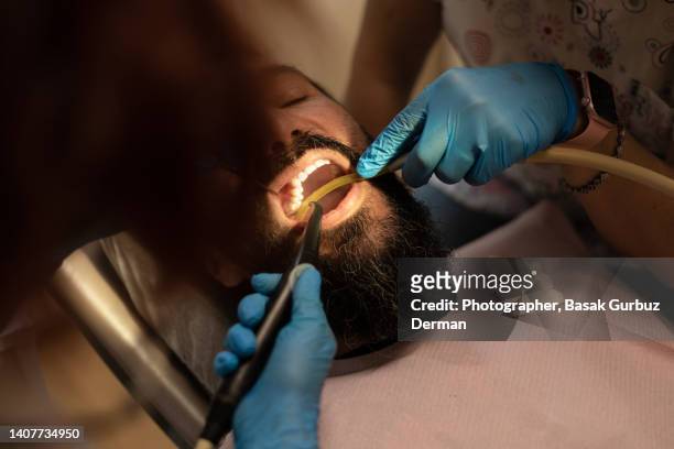 medical procedure at dentist - plaque bacteria fotografías e imágenes de stock