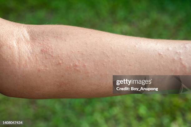 close up of skin rashes occur on men's hand. - sun burn stock pictures, royalty-free photos & images