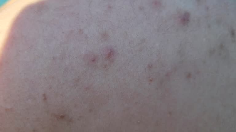 Back Rash Acne 63 Acne Rash Stock Videos, Footage, & 4K Video Clips - Getty Images