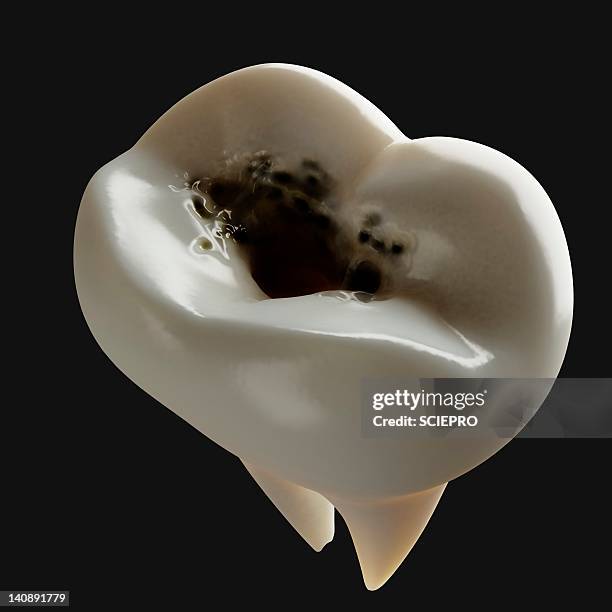 Toot Rotten Inside 73 Black Rotten Teeth Stock Photos, High-Res Pictures, and Images ...