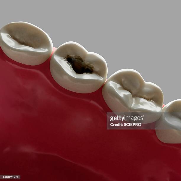 ilustraciones, imágenes clip art, dibujos animados e iconos de stock de tooth decay, artwork - plaque bacteria
