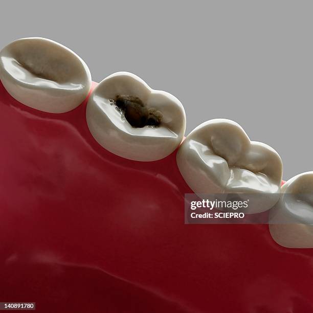 Toot Rotten Inside 73 Black Rotten Teeth Stock Photos, High-Res Pictures, and Images ...