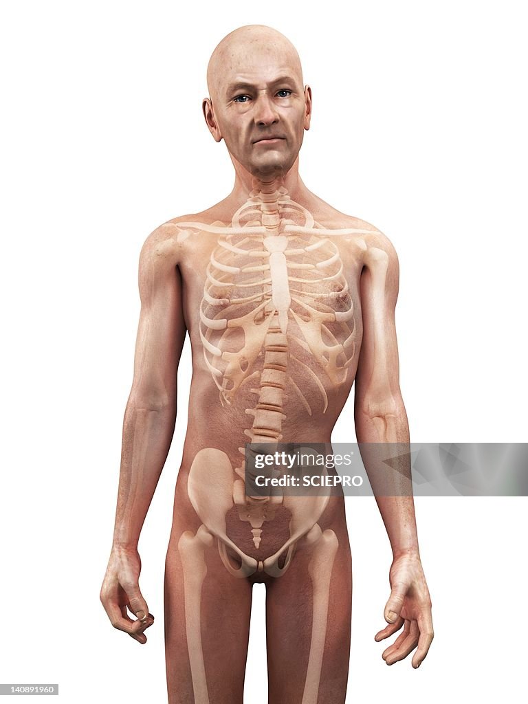 Scoliosis of the spine, artwork