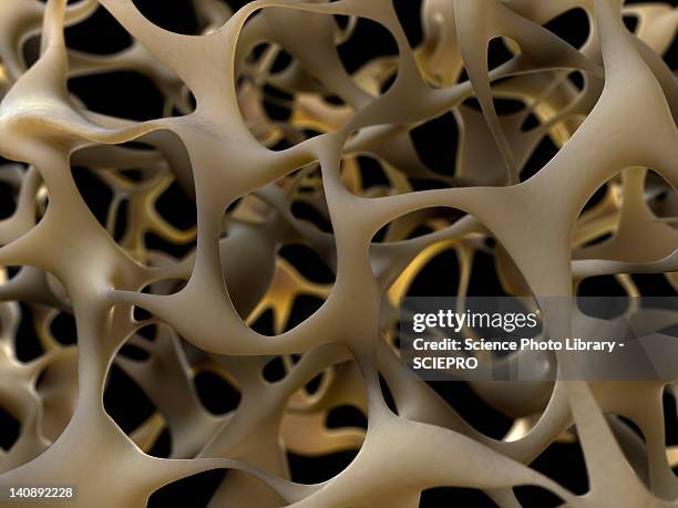 ilustraciones, imágenes clip art, dibujos animados e iconos de stock de osteoporotic bone, artwork - hueso humano