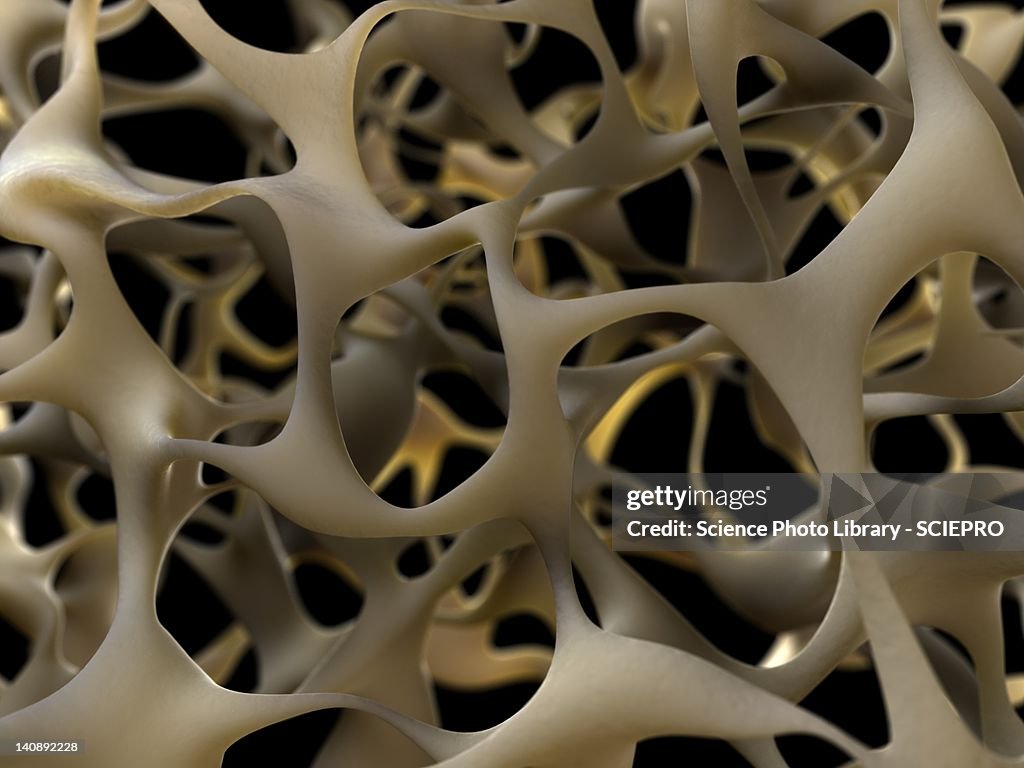 Osteoporotic bone, artwork