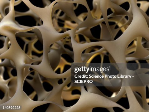 Osteoporotic bone, artwork Osteoporotic bone, artwork