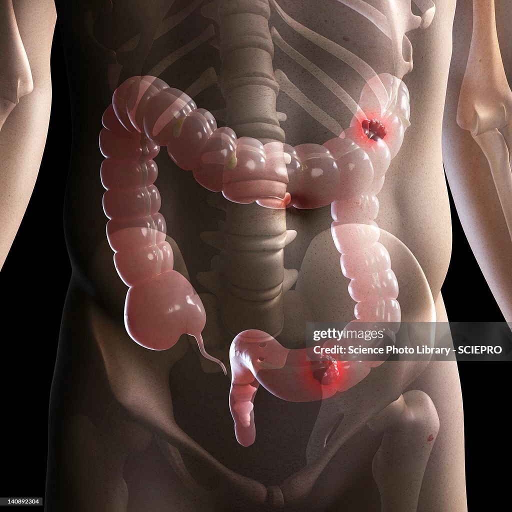 Bowel cancer, artwork