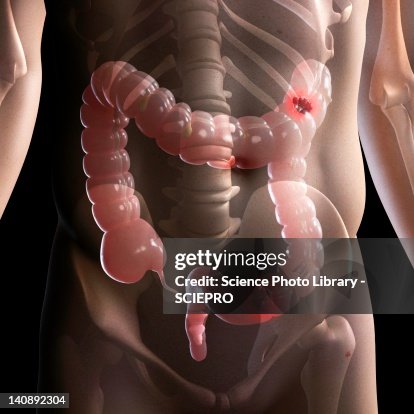 Bowel cancer, artwork Bowel cancer, artwork