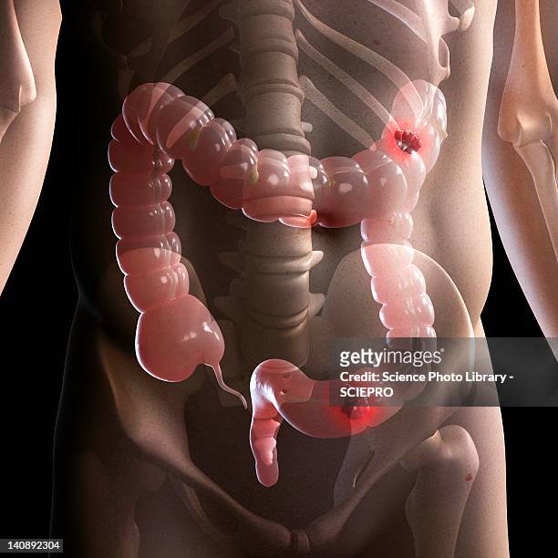 bowel cancer, artwork - intestine stock illustrations