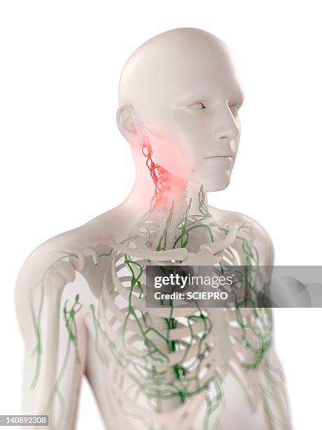 Vishochov Node 103 Swollen Lymph Nodes Stock Photos, High-Res Pictures, and Images ...