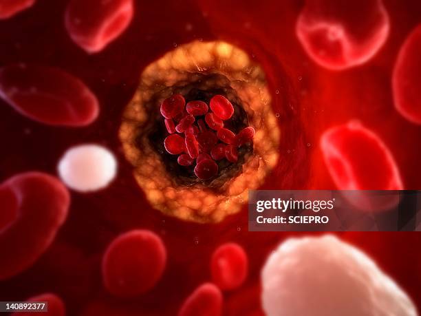 narrowed artery, artwork - atherosklerose stock-grafiken, -clipart, -cartoons und -symbole