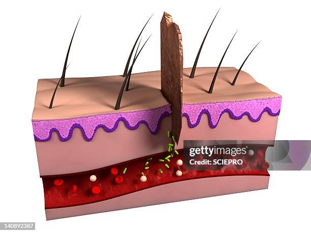 Skin Infections Draw Wound Infection Artwork High-Res Vector Graphic - Getty Images