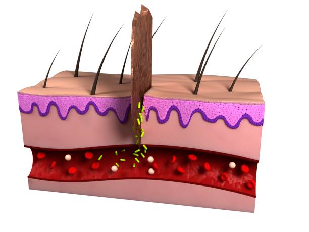 Skin Infections Draw 1,049 Lupus Skin High Res Illustrations - Getty Images