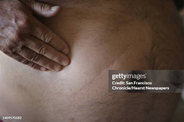 Scott Barnes shows his surgery scar in his San Luis Obispo home on Wednesday, April 30 where doctors opened him up with the intent of giving him a...
