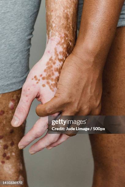 midsection of woman with skin with vitiligo and hands on body,united states,usa - close up body part stock pictures, royalty-free photos & images