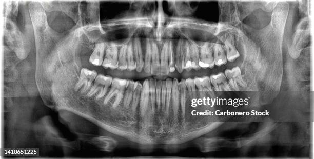 3d panoramic x-ray of an adult male's teeth - röntgenbild bildbanksfoton och bilder