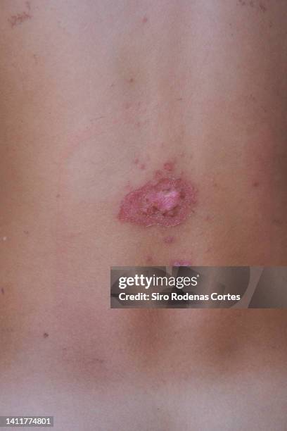infected impetigo wound - impetigo stock-fotos und bilder