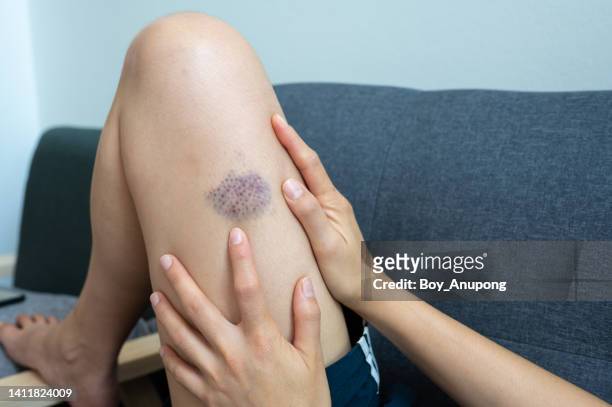 close up of bruise occur on woman leg. bruising can occur more easily as we age due to thinning of the skin. - coagulation stock pictures, royalty-free photos & images
