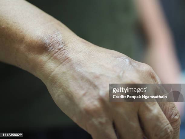 blister on the back of a woman's hand - leprosy stock pictures, royalty-free photos & images