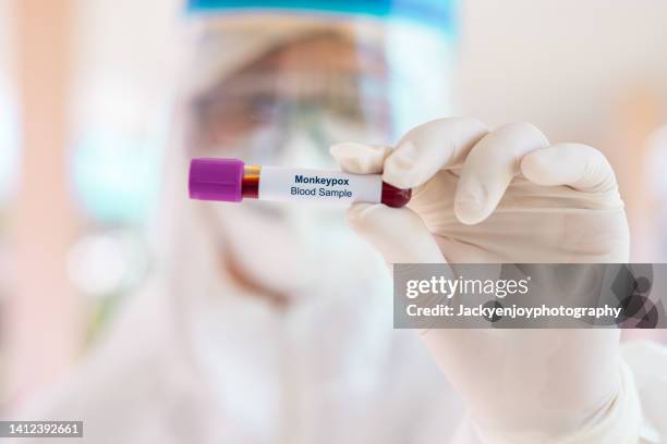 monkeypox virus blood sample - pox stock pictures, royalty-free photos & images
