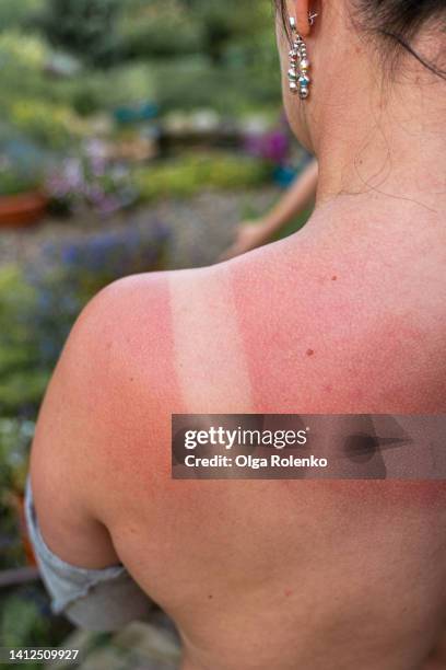 sunburn skin on woman back - quemado por el sol fotografías e imágenes de stock