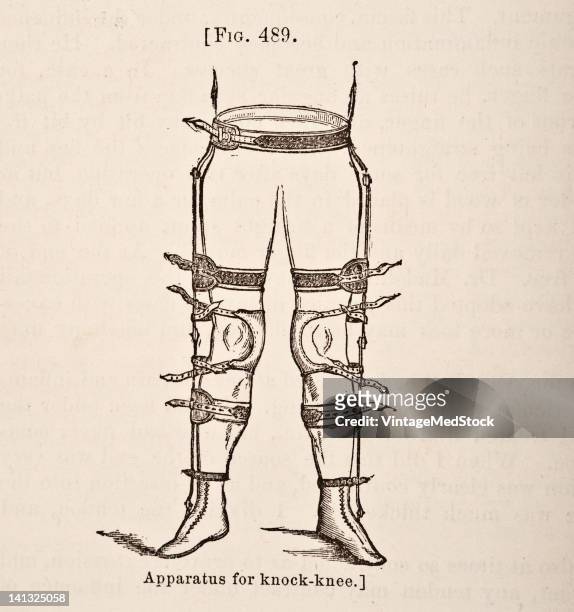 Medical engraving from A Manual for the Practice of Surgery illustrates the appatatus for knock-knee , 1881.