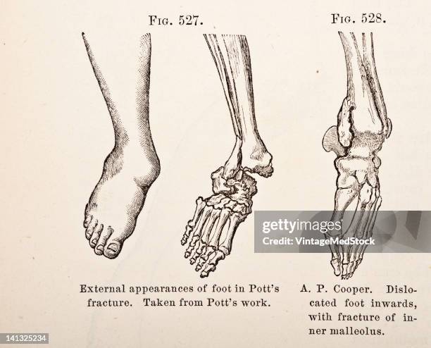 Medical engraving from A Manual for the Practice of Surgery illustrates Pott's fracture and a foot dislocated inwards, 1881.