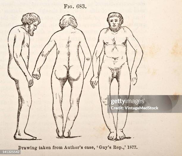 Medical engraving from A Manual for the Practice of Surgery illustrates Paget's disease, that is characterized by abnormal bone destruction and...