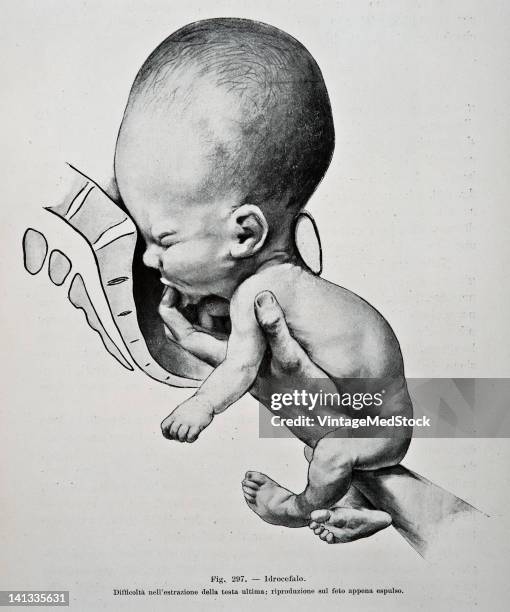 Medical drawing from Trattato Completo di Ostetricia illustrates a human baby with hydrocephalus moving through the birth canal, 1905.