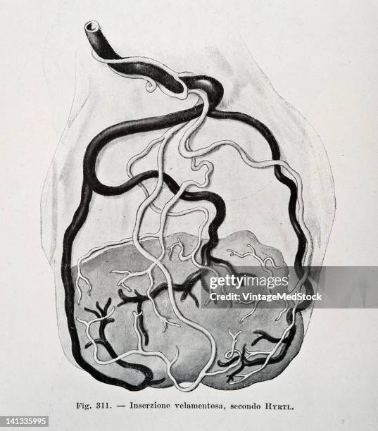 Medical drawing from Trattato Completo di Ostetricia illustrates the human placenta, 1905.